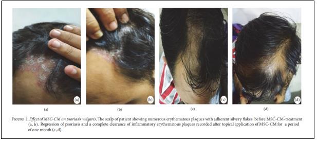 圖2：MSC-CM對尋常型銀屑病的影響。