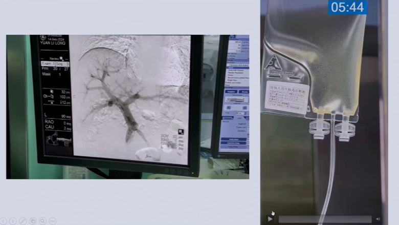 殷浩教授展示了干細胞療法的治療過(guò)程