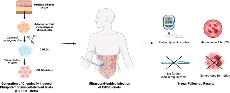 圖示：?通過(guò)將患者脂肪組織提取的間充質(zhì)干細胞化學(xué)重編程為誘導多能干細胞并分化為胰島，再注射入腹直肌前鞘。
