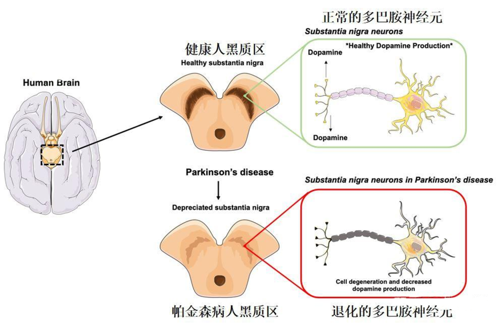 帕金森病患者的腦部黑質(zhì)區