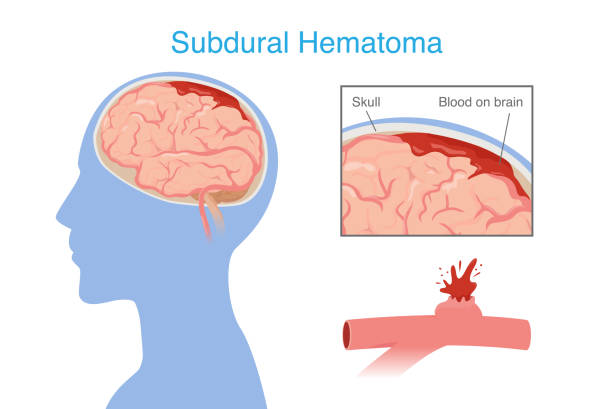 神經(jīng)干細胞移植治療腦出血的系統評價(jià)：NSC來(lái)源、輸送途徑、治療機制和早期臨床試驗